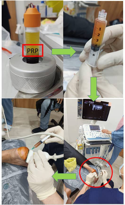 PRP therapy