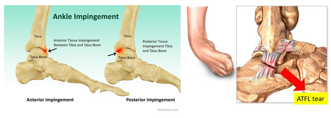 Ankle treatment