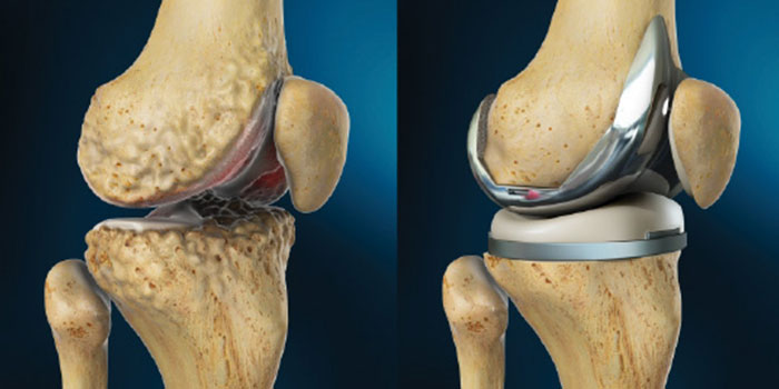 Total knee replacement
