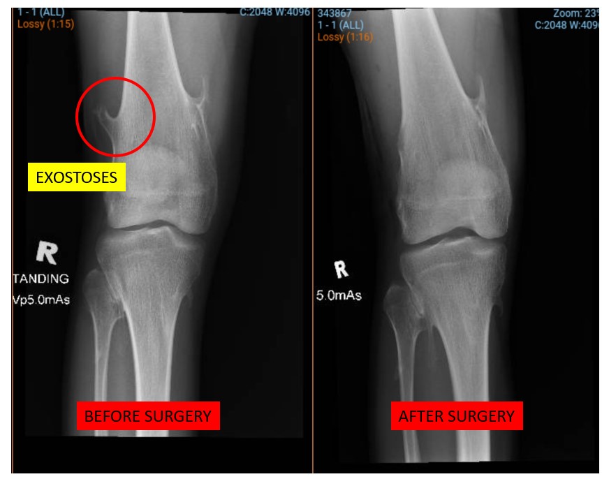 Exostoses case — before treatment