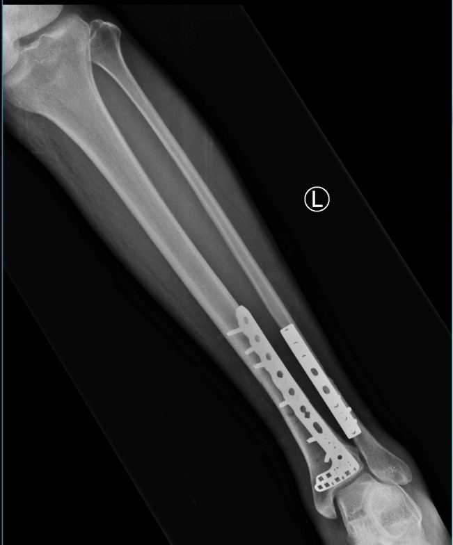 After surgery — trauma case