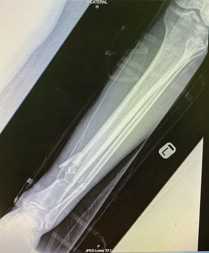 Before surgery — trauma case