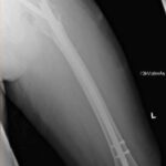 Hip fracture case — clinical image