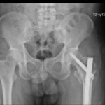 Hip fracture case — follow-up
