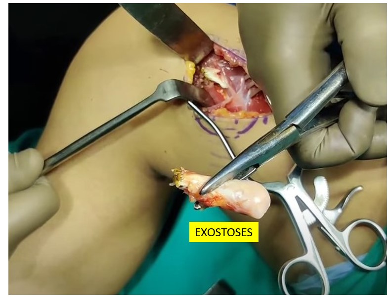 Exostoses case