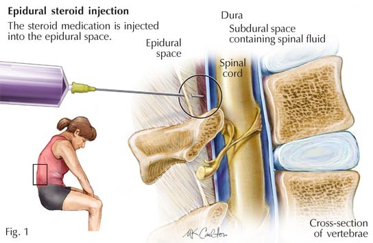 Epidural steroid injection