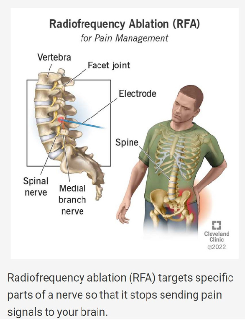 Radiofrequency ablation