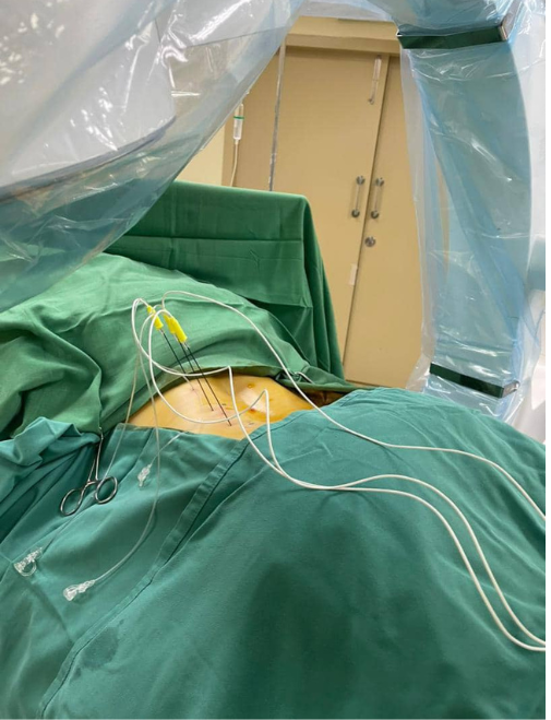 Pain management — RFA procedure