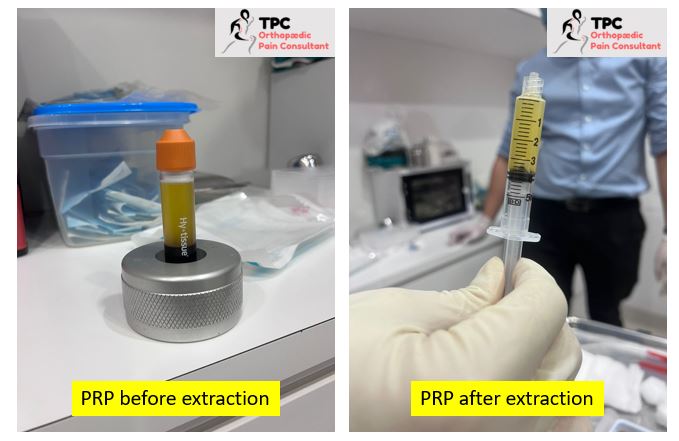 Knee osteoarthritis — PRP therapy