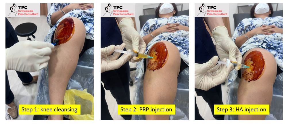 Knee joint — conservative PRP treatment