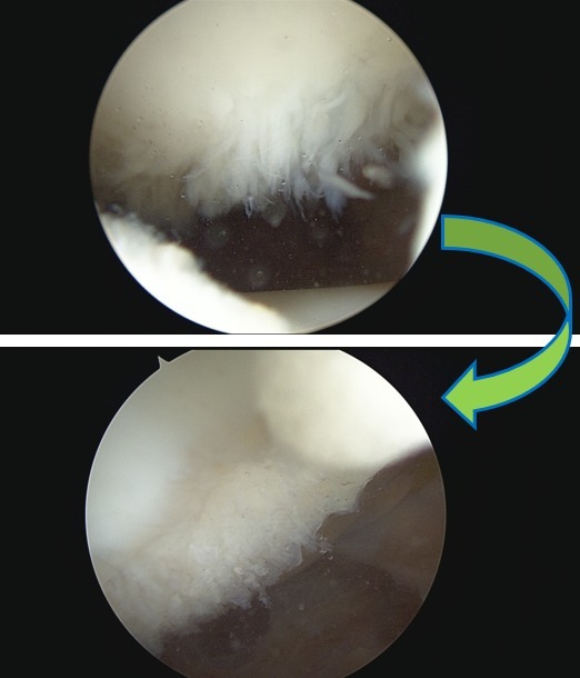 Patella — before and after arthroscopy