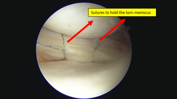 Meniscus injury — illustration