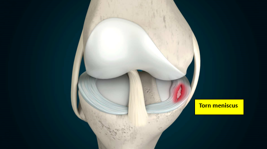 Meniscus injury — treatment
