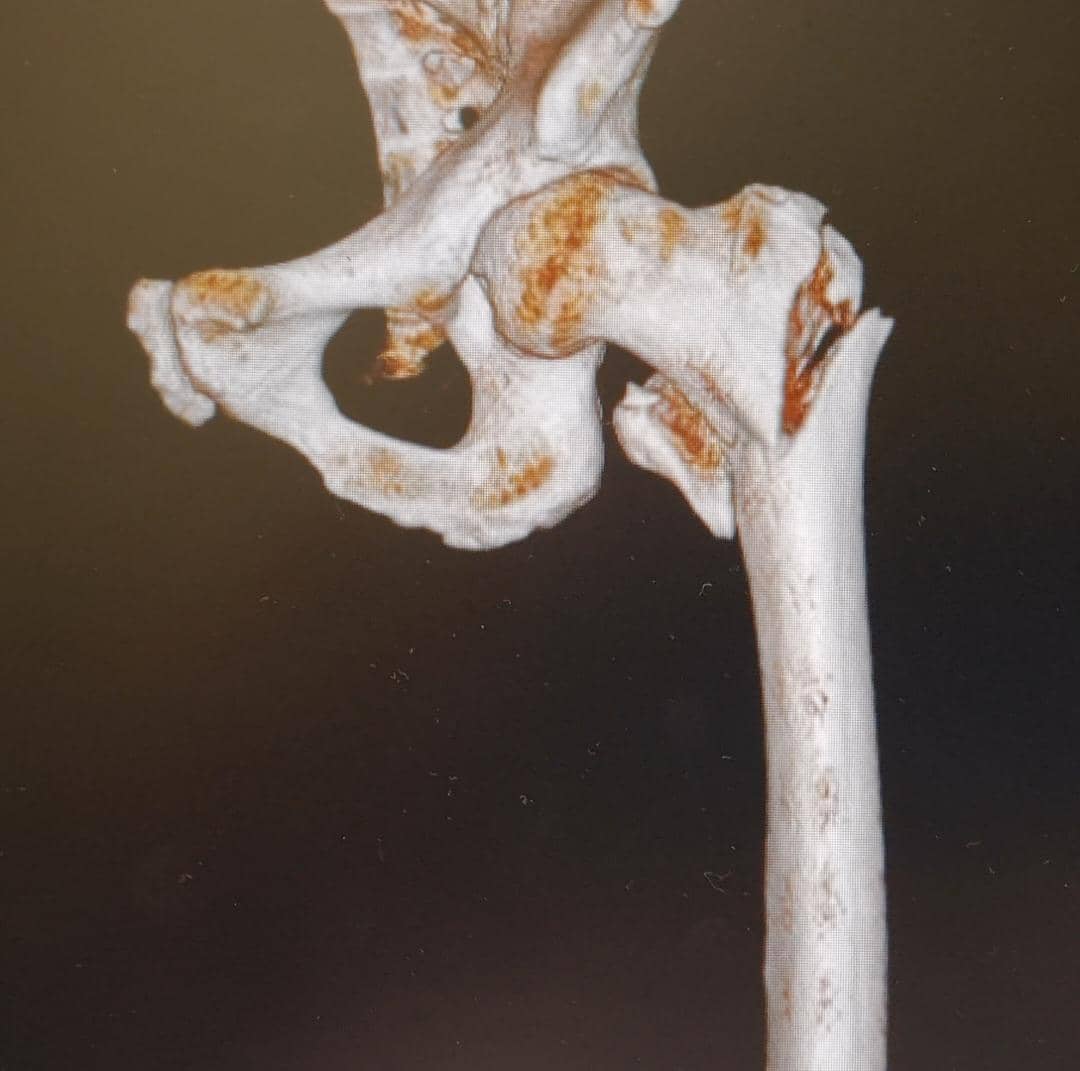 Fracture management