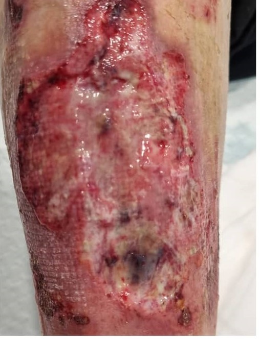 1 day after surgery