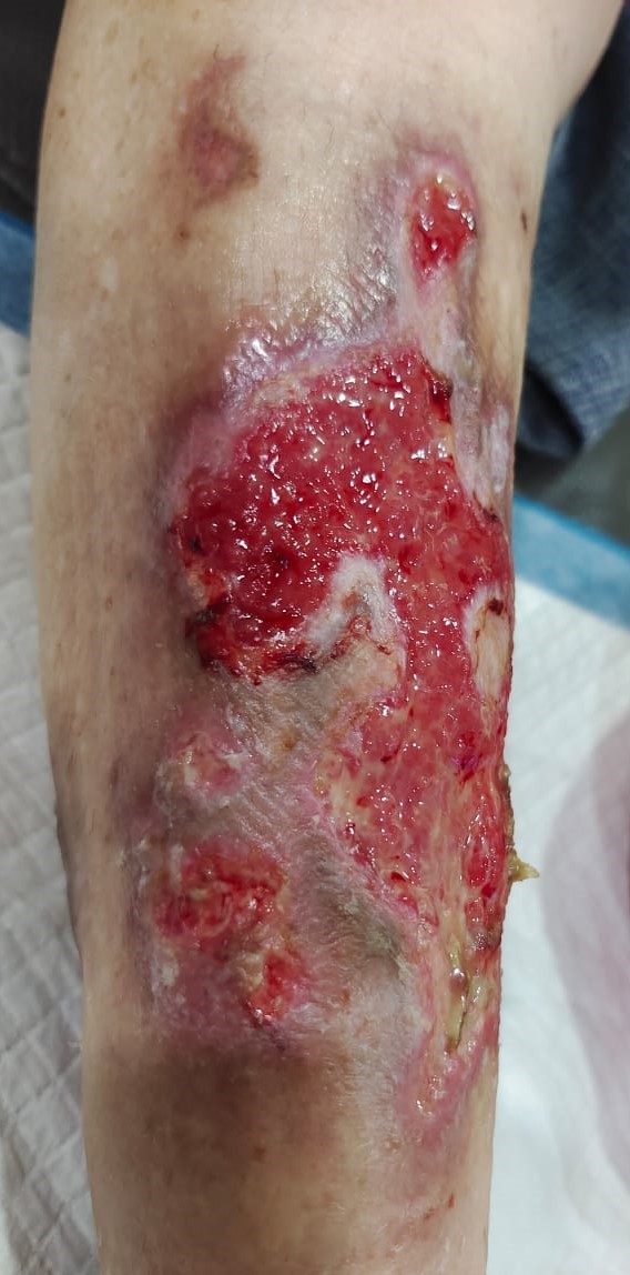 1 month after surgery